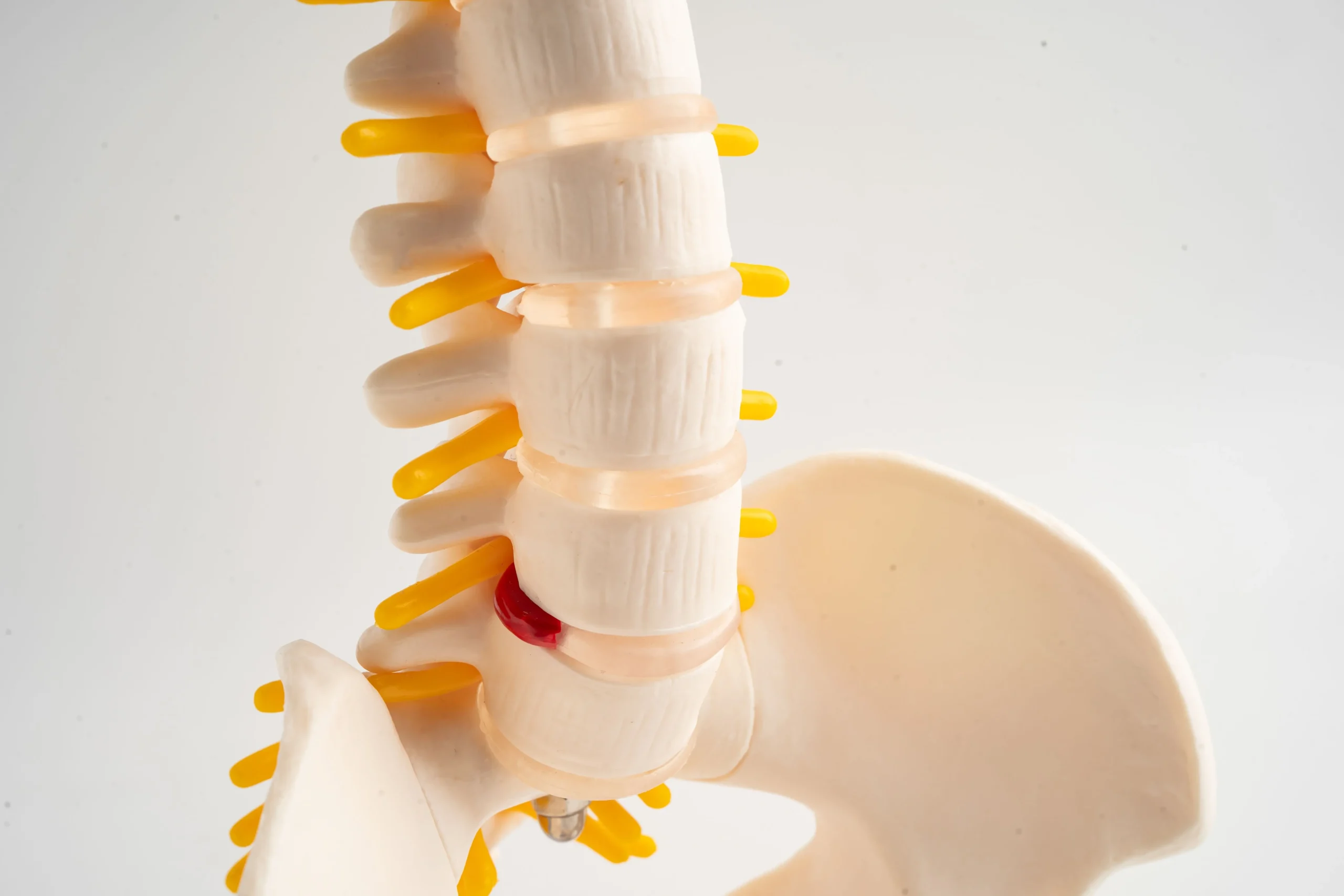 disc-herniation-img